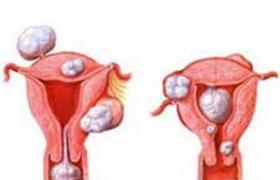 妊娠合並子宮肌瘤 纖維肌瘤 子宮纖維瘤 子宮平滑肌瘤 子宮肌瘤