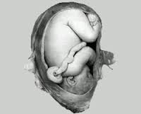 胎死宮內 子宮內死胎 死胎