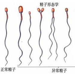 精子畸形 畸形精子