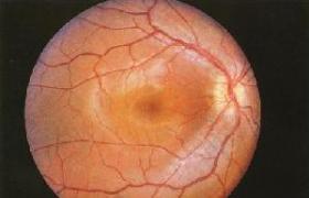 視神經萎縮 optic atrophy OA