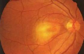 視網膜母細胞瘤 成視網膜細胞瘤 視網膜成神經細胞瘤 視網膜惡性膠質瘤