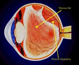 玻璃體疝 H43.001 Vitreous hernia