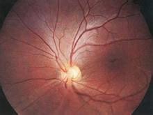 先天性視網膜劈裂 青年性視網膜劈裂癥 先天性玻璃體血管紗膜癥 性連鎖性青年性視網膜分離癥