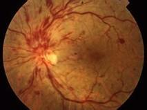 視網膜中央靜脈阻塞 H34.803
