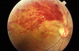視網膜中央動脈阻塞