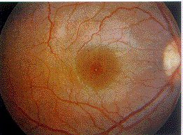 視網膜後膜