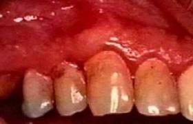 牙齦出血 K06.802