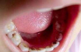 齲齒 K02.901 蛀牙 爛牙 蟲牙 齲病