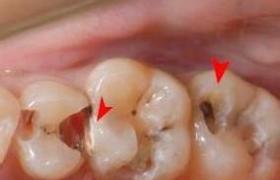牙髓炎 K04.005 Pulpitis 牙髓退變 牙髓壞死 牙髓病