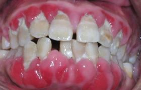 牙周病 K05.501
