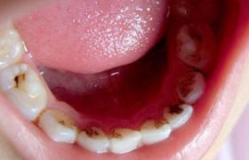 急性牙髓炎 K04.002 Acute pulpitis
