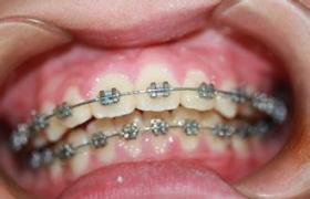 暴牙 齙牙 鳥嘴畸形 上下頜前突 突頜畸形