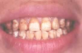 氟牙癥 斑釉牙 氟斑牙