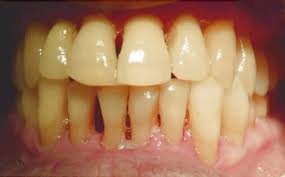 牙周萎縮 牙齦退縮 邊緣組織退縮