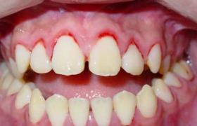 青少年牙周炎 早發性牙周炎