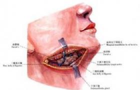 急性頜下腺炎