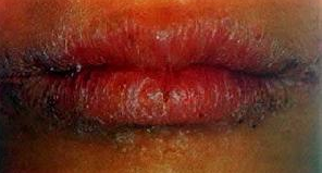 唇病 糜爛型唇炎 幹燥脫屑型唇 腺型唇炎 肉芽腫