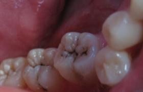 牙體病 齲齒 齲牙