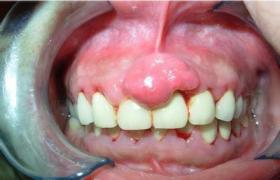 牙齦瘤
