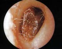 外耳道異物 T16.X52
