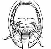 先天性鼻咽部狹窄及閉鎖