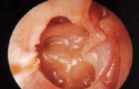 急性化膿性中耳炎 H66.001 中耳炎
