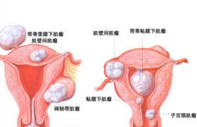 子宮肌瘤 子宮良性腫瘤