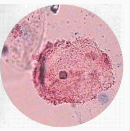 細菌性陰道炎 N76.003 細菌性陰道病 非特異性陰道炎