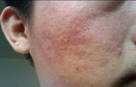 脂溢性皮炎 L21.901 脂溢性皮炎 seborrheic dermatitis