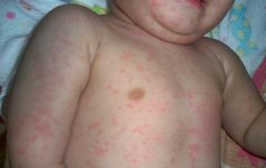 兒童蕁麻疹