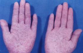 掌蹠膿皰病 L40.351 限局性膿皰型銀屑病