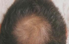 早禿 男式脫發 傢族性禿發 脂溢性脫發 遺傳性脫發 雄性激素源性脫發