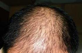 男性型禿發 男子雄激素源性禿發 男性型脫發 雄激素性脫發