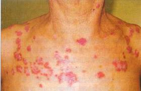 全身性紅斑狼瘡 系統性紅斑狼瘡