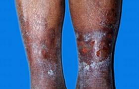 老年人淤滯性皮炎 淤積性濕疹 重力性濕疹 低張力性皮炎
