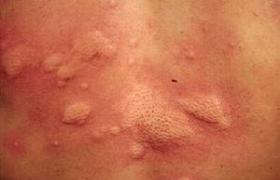 色素性蕁麻疹 留有褐色斑的慢性蕁麻疹