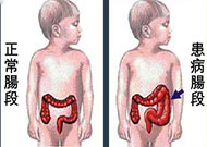 小兒先天性巨結腸 無神經節細胞癥 先天性巨腸