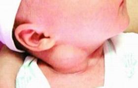小兒先天性斜頸 小兒先天性肌性斜頸 小兒捩頸