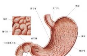 新生兒胃穿孔