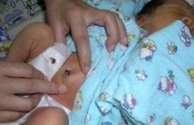 新生兒臍肉芽腫