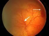 早產兒視網膜病變 晶狀體後纖維增生癥 晶體後纖維膜增生癥