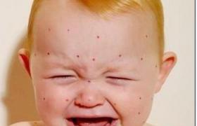 小兒系統性紅斑狼瘡