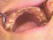 小兒牙本質生長不全綜合征 小兒Capdepone綜合征 小兒Stainton綜合征