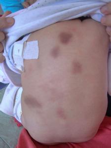 小兒色素蕁麻疹 小兒類黃瘤 小兒良性泛發性皮膚肥大細胞增