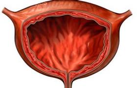小兒巨大膀胱-巨大輸尿管綜合征