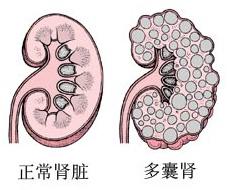 小兒多囊腎 囊胞腎 腎臟良性多房性囊瘤