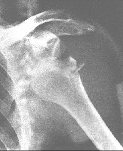 肩關節脫位 S43.001 dislocation of joints