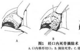 化膿性頜骨骨髓炎 急性頜骨骨髓炎