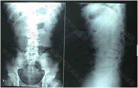 椎體爆裂骨折 垂直壓縮性骨折椎體破裂性骨折