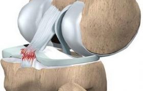 膝關節內側副韌帶斷裂